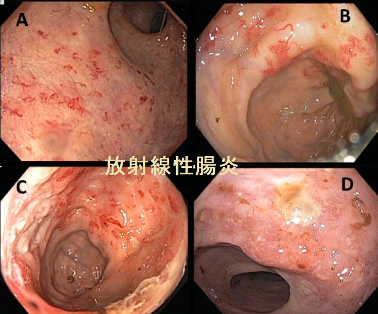 放射線性腸炎 放射線性腸炎