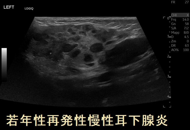 若年性再発性慢性耳下腺炎 若年性再発性慢性耳下腺炎