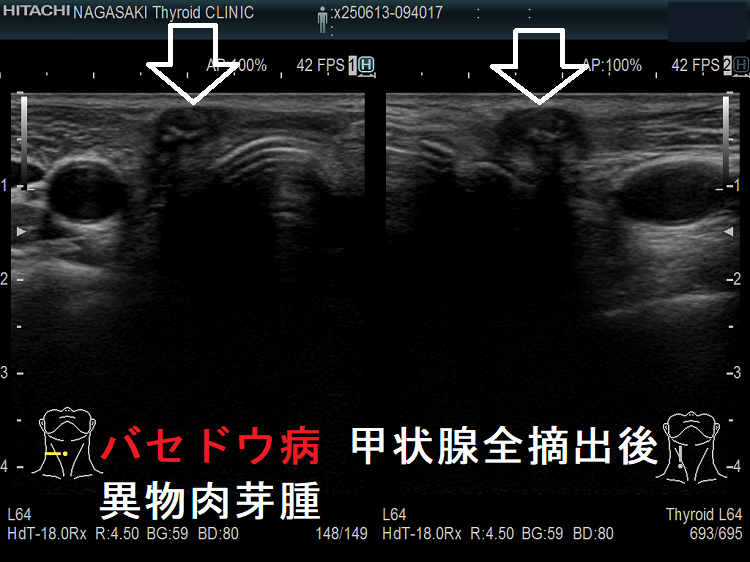 バセドウ病 甲状腺全摘出後 異物肉芽腫 バセドウ病 甲状腺全摘出後 異物肉芽腫