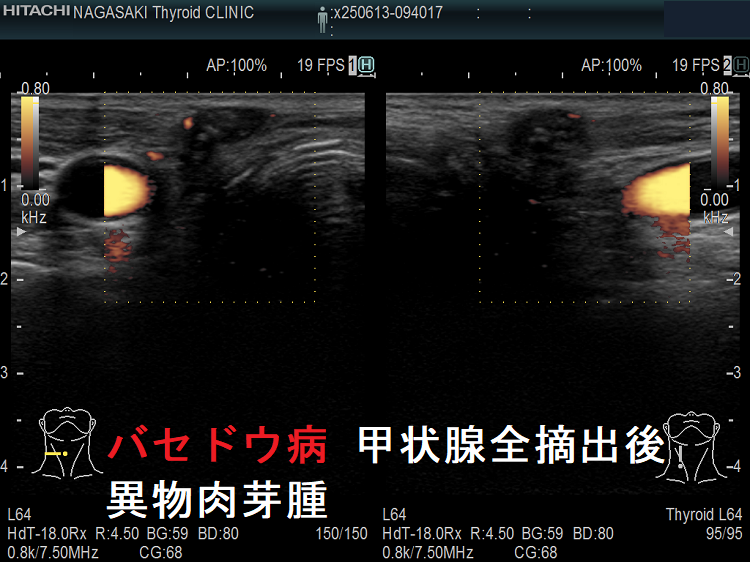 バセドウ病 甲状腺全摘出後 異物肉芽腫 ドプラーモード バセドウ病 甲状腺全摘出後 異物肉芽腫 ドプラーモード