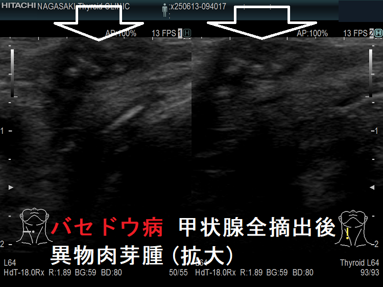 バセドウ病 甲状腺全摘出後 異物肉芽腫(拡大) バセドウ病 甲状腺全摘出後 異物肉芽腫(拡大)