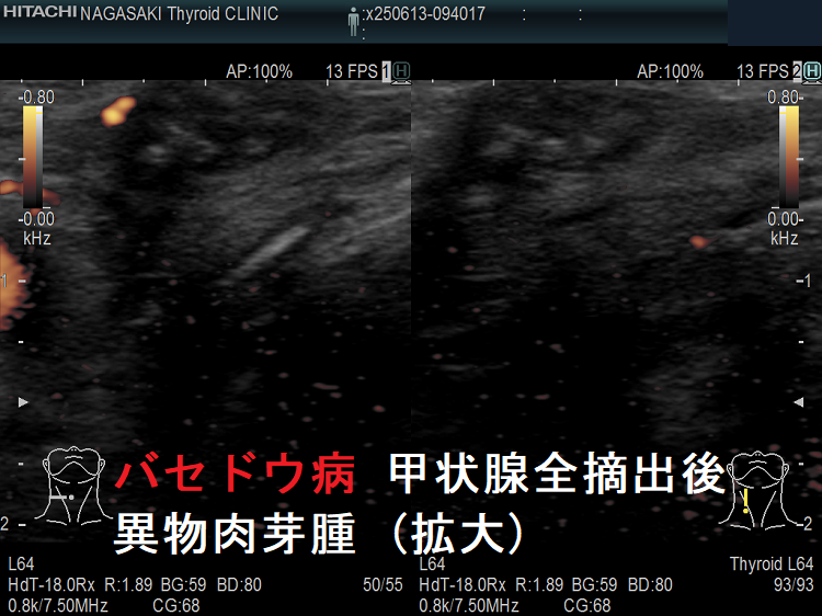 バセドウ病 甲状腺全摘出後 異物肉芽腫 (拡大)ドプラーモード バセドウ病 甲状腺全摘出後 異物肉芽腫 (拡大)ドプラーモード