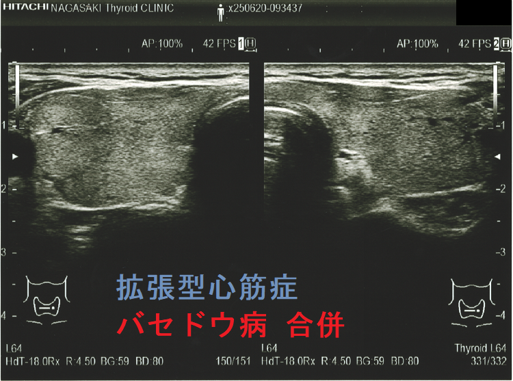 拡張型心筋症 甲状腺機能亢進症/バセドウ病 合併 超音波(エコー)画像 拡張型心筋症 甲状腺機能亢進症/バセドウ病 合併 超音波(エコー)画像