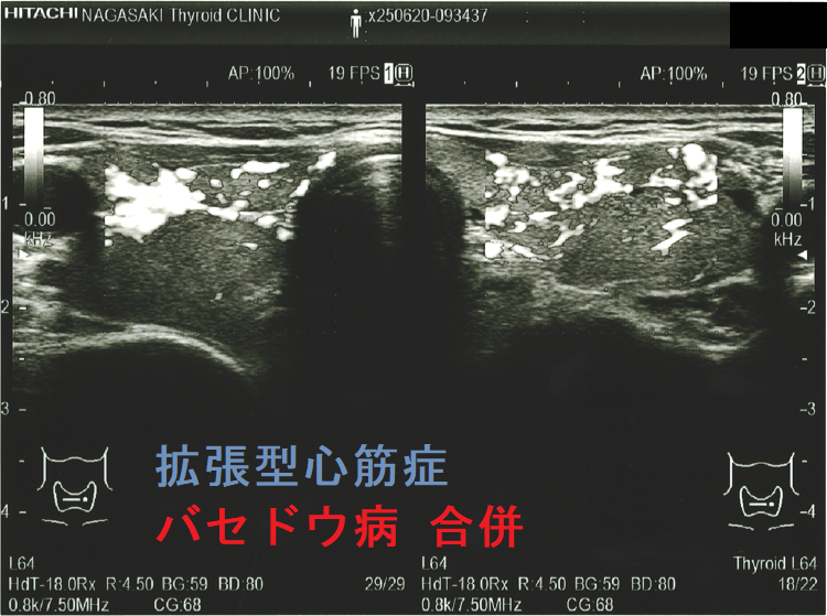 拡張型心筋症 甲状腺機能亢進症/バセドウ病 合併 超音波(エコー)画像 ドプラーモード 拡張型心筋症 甲状腺機能亢進症/バセドウ病 合併 超音波(エコー)画像 ドプラーモード