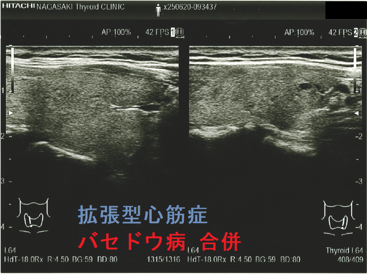 拡張型心筋症 甲状腺機能亢進症/バセドウ病 合併 超音波(エコー)画像 (矢状断) 拡張型心筋症 甲状腺機能亢進症/バセドウ病 合併 超音波(エコー)画像 (矢状断)