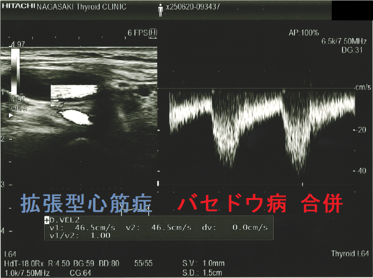 拡張型心筋症 甲状腺機能亢進症/バセドウ病 合併 超音波(エコー)画像 下甲状腺動脈血流速度(ITA-PSV)測定 拡張型心筋症 甲状腺機能亢進症/バセドウ病 合併 超音波(エコー)画像 下甲状腺動脈血流速度(ITA-PSV)測定