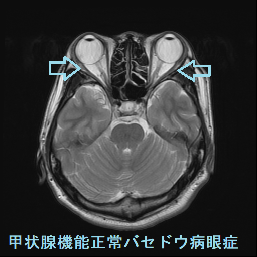 甲状腺機能正常バセドウ病眼症 MRI T2強調画像 甲状腺機能正常バセドウ病眼症 MRI T2強調画像