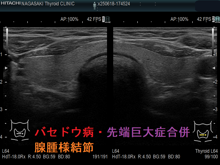 バセドウ病・先端巨大症合併 腺腫様結節 超音波(エコー)画像 バセドウ病・先端巨大症合併 腺腫様結節 超音波(エコー)画像