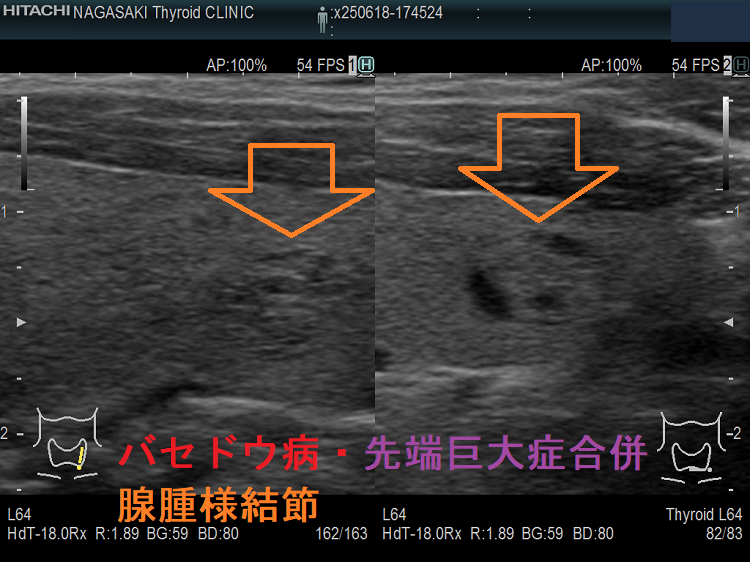 バセドウ病・先端巨大症合併患者に発生した腺腫様結節 超音波(エコー)画像(拡大) バセドウ病・先端巨大症合併患者に発生した腺腫様結節 超音波(エコー)画像(拡大)