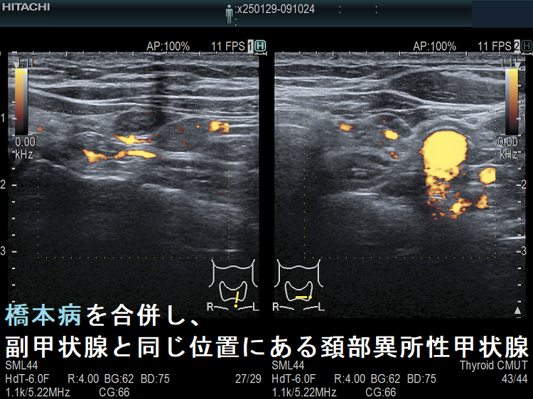 橋本病を合併し、副甲状腺と同じ位置にある頚部異所性甲状腺 ドプラーモード 橋本病を合併し、副甲状腺と同じ位置にある頚部異所性甲状腺 ドプラーモード