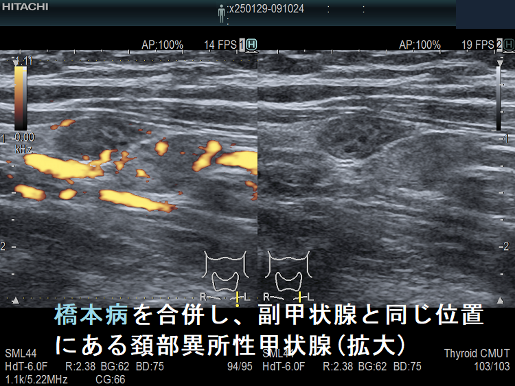 橋本病を合併し、副甲状腺と同じ位置にある頚部異所性甲状腺(拡大)ドプラーモード 橋本病を合併し、副甲状腺と同じ位置にある頚部異所性甲状腺(拡大)ドプラーモード