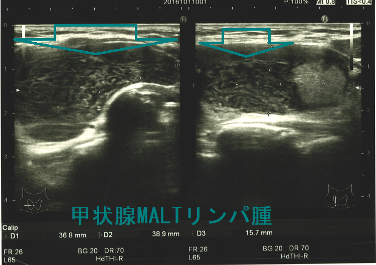甲状腺MALTリンパ腫 甲状腺MALTリンパ腫