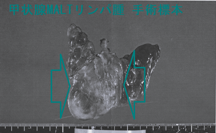 甲状腺MALTリンパ腫 手術標本1 甲状腺MALTリンパ腫 手術標本1-1