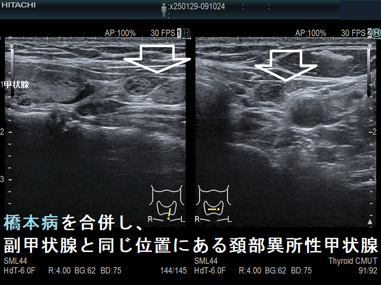 橋本病を合併し、副甲状腺と同じ位置にある頚部異所性甲状腺 橋本病を合併し、副甲状腺と同じ位置にある頚部異所性甲状腺1
