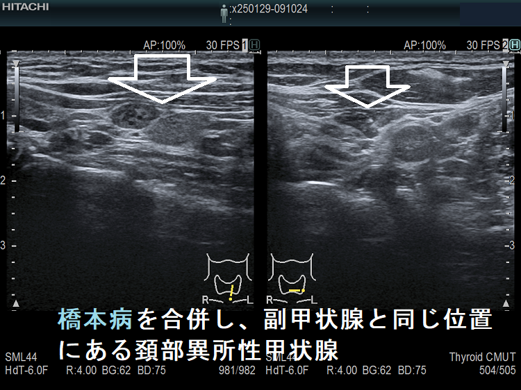 橋本病を合併し、副甲状腺と同じ位置にある頚部異所性甲状腺2 橋本病を合併し、副甲状腺と同じ位置にある頚部異所性甲状腺2