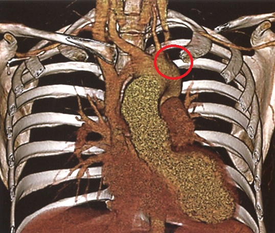 大動脈炎症候群 左鎖骨下動脈狭窄 三次元造影CT 大動脈炎症候群 左鎖骨下動脈狭窄 三次元造影CT