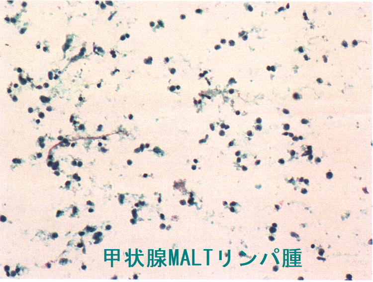 甲状腺MALTリンパ腫 細胞診1 (弱拡大) 甲状腺MALTリンパ腫 細胞診1 (弱拡大)