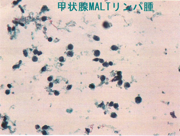 甲状腺MALTリンパ腫 細胞診2 (強拡大) 甲状腺MALTリンパ腫 細胞診2 (強拡大)