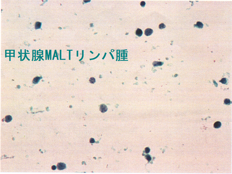 甲状腺MALTリンパ腫 細胞診3 (強拡大) 甲状腺MALTリンパ腫 細胞診3 (強拡大)