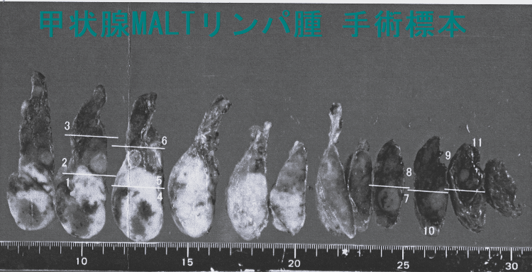 甲状腺MALTリンパ腫 手術標本2 甲状腺MALTリンパ腫 手術標本2-1