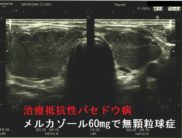 治療抵抗性バセドウ病 メルカゾール60mgで無顆粒球症 超音波(エコー)画像(水平断) 治療抵抗性バセドウ病 メルカゾール60mgで無顆粒球症 超音波(エコー)画像(水平断)