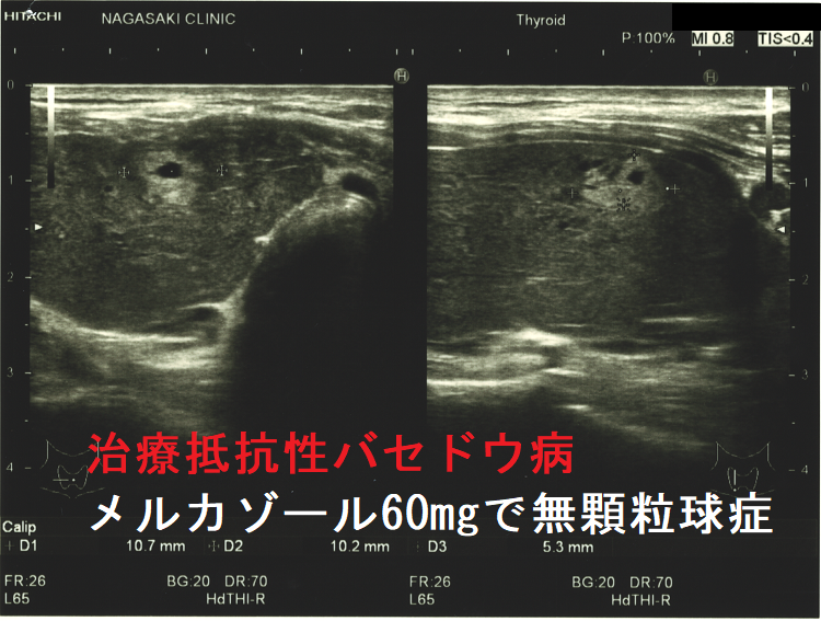 治療抵抗性バセドウ病 メルカゾール60mgで無顆粒球症 超音波(エコー)画像 (矢状断) 治療抵抗性バセドウ病 メルカゾール60mgで無顆粒球症 超音波(エコー)画像 (矢状断)
