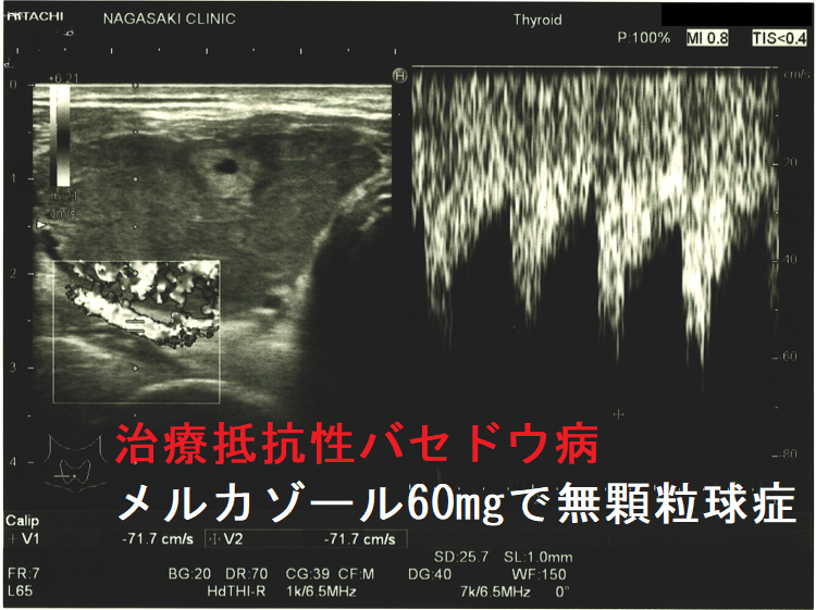 治療抵抗性バセドウ病 メルカゾール60mgで無顆粒球症 超音波(エコー)画像 下甲状腺動脈血流速度(ITA-PSV) 治療抵抗性バセドウ病 メルカゾール60mgで無顆粒球症 超音波(エコー)画像 下甲状腺動脈血流速度(ITA-PSV)