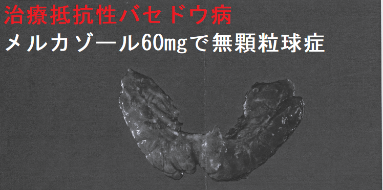 治療抵抗性バセドウ病 メルカゾール60mgで無顆粒球症 手術標本1 治療抵抗性バセドウ病 メルカゾール60mgで無顆粒球症 手術標本1