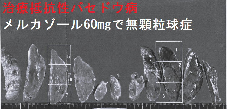治療抵抗性バセドウ病 メルカゾール60mgで無顆粒球症 手術標本2 治療抵抗性バセドウ病 メルカゾール60mgで無顆粒球症 手術標本2