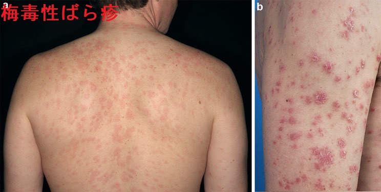 梅毒と甲状腺 梅毒第2期 梅毒性ばら疹 梅毒と甲状腺 梅毒第2期 梅毒性ばら疹