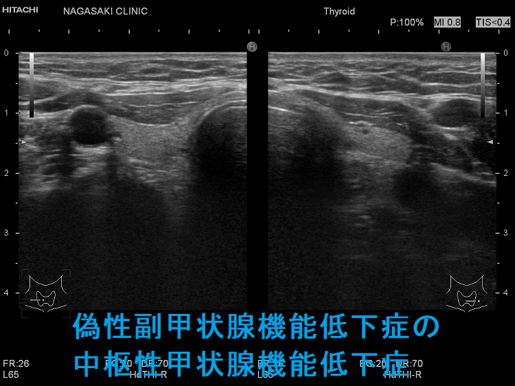 偽性副甲状腺機能低下症の中枢性甲状腺機能低下症 偽性副甲状腺機能低下症の中枢性甲状腺機能低下症