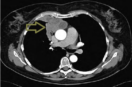 胸腺癌(悪性胸腺腫、浸潤性胸腺腫) 胸腺癌(悪性胸腺腫、浸潤性胸腺腫)