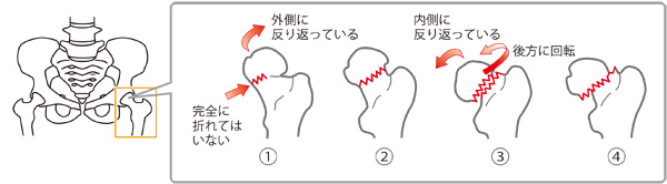 大腿骨頚部骨折 大腿骨頚部骨折