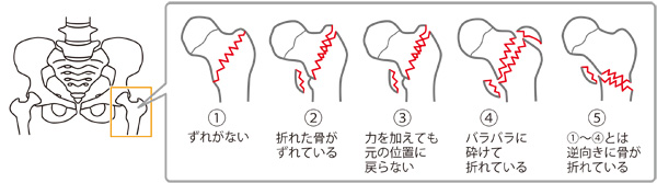 大腿骨転子部骨折 大腿骨転子部骨折