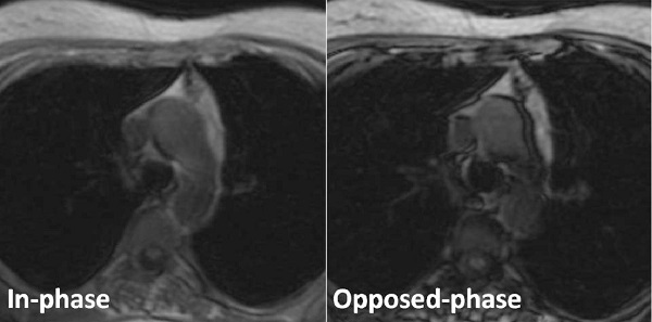 胸腺過形成 MR脂肪抑制像(化学シフトMRイメージング) 胸腺過形成 MR脂肪抑制像(化学シフトMRイメージング)