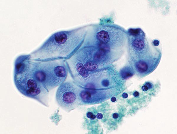 甲状腺びまん性硬化型乳頭癌の細胞診 甲状腺びまん性硬化型乳頭癌の細胞診