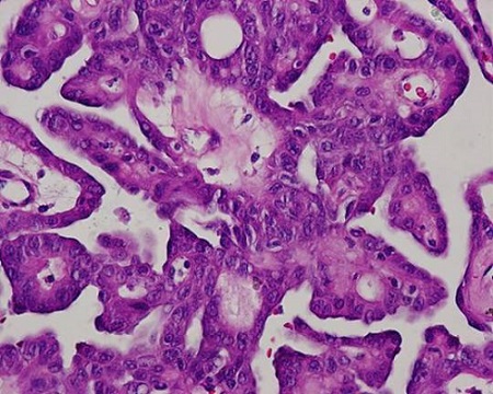 甲状腺乳頭癌モルラ型 病理組織(高細胞) 甲状腺乳頭癌モルラ型 病理組織(高細胞)