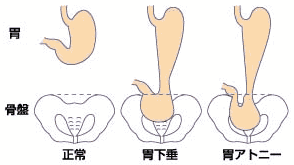 胃下垂 胃下垂