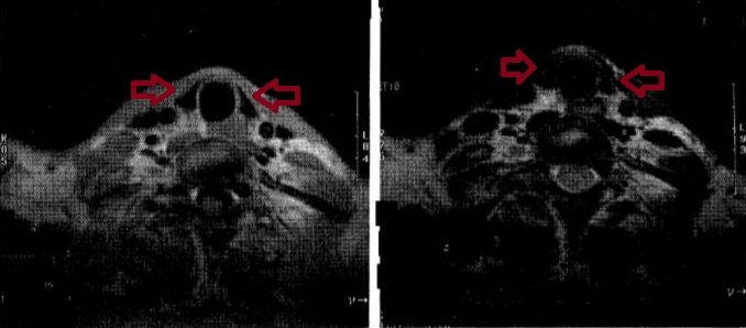甲状腺単純MRI Tl,T2強調画像 甲状腺単純MRI Tl,T2強調画像