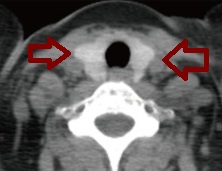 甲状腺ヘモクロマトーシス CT画像 甲状腺ヘモクロマトーシス CT画像