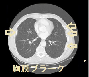 胸膜プラーク CT画像 胸膜プラーク CT画像