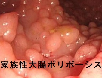 家族性大腸腺腫症 家族性大腸腺腫症