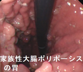 家族性大腸ポリポーシス 胃 家族性大腸ポリポーシス 胃