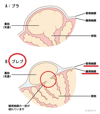 ブレブ ブレブ