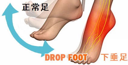 下垂足 下垂足