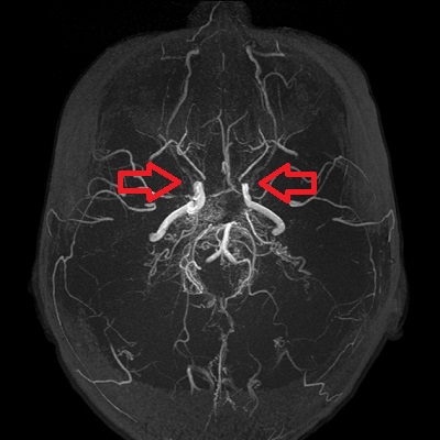 モヤモヤ病 MRA 画像 モヤモヤ病 MRA 画像