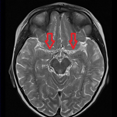もやもや病 MRI T2画像 もやもや病 MRI T2画像