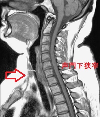 声門下狭窄症 CT画像 声門下狭窄症 CT画像