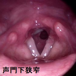 声門下狭窄症 喉頭鏡 声門下狭窄症 喉頭鏡