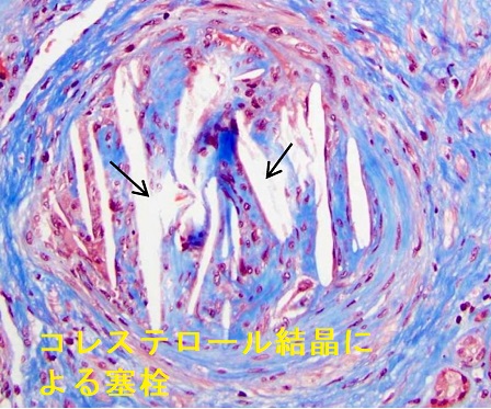 腎生検 コレステロール結晶 腎生検 コレステロール結晶